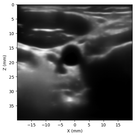 Despeckled B-mode carotid image
