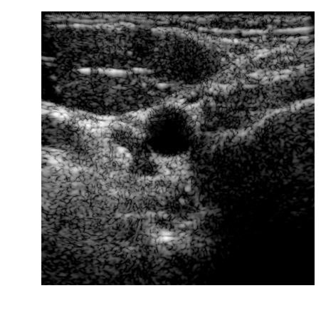 B-mode carotid image