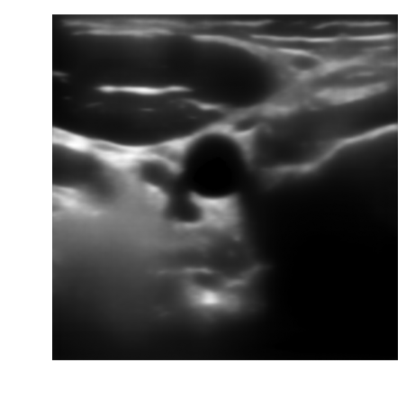 Despeckled B-mode carotid image